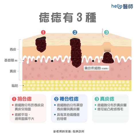 痣的形成原因|痣形成的原因？痣長毛、痣變多變大是痣病變？5招判別